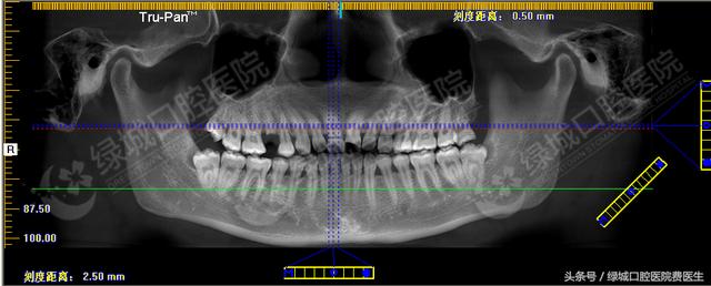 人類(lèi)的第三副牙齒——種植牙