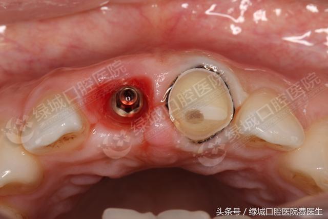 人類(lèi)的第三副牙齒——種植牙