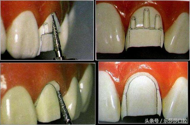 牙醫曝光：烤瓷牙那點(diǎn)不為人知的事！