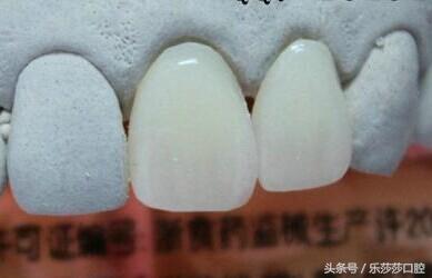 牙醫曝光：烤瓷牙那點(diǎn)不為人知的事！