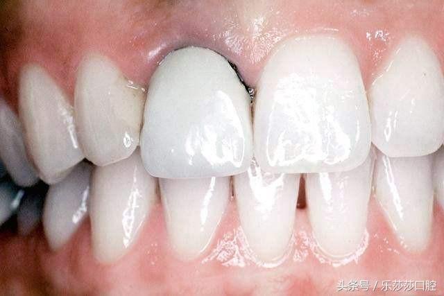 牙醫曝光：烤瓷牙那點(diǎn)不為人知的事！