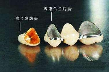烤瓷牙真的是條不歸路？