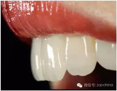 口腔美學(xué)修復策略之牙齒尺寸