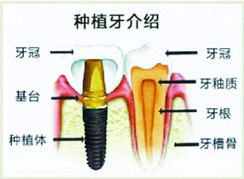種植牙可以使用一輩子嗎？