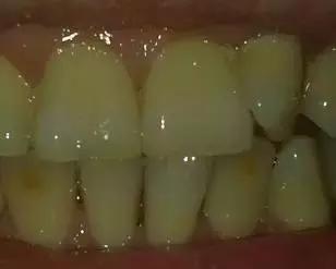 口腔美學(xué)修復，期待您的蛻變