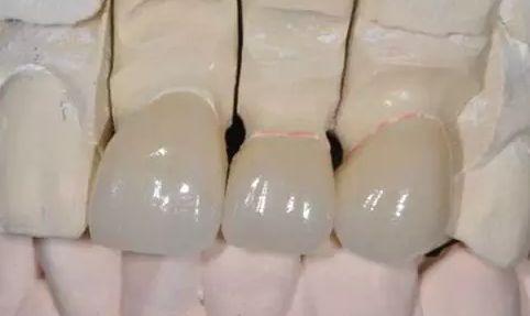 為什么有些烤瓷牙做了會(huì )讓牙齦變黑？