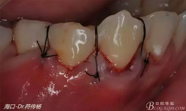 病例分享｜牙齦再生&根面覆蓋術(shù)