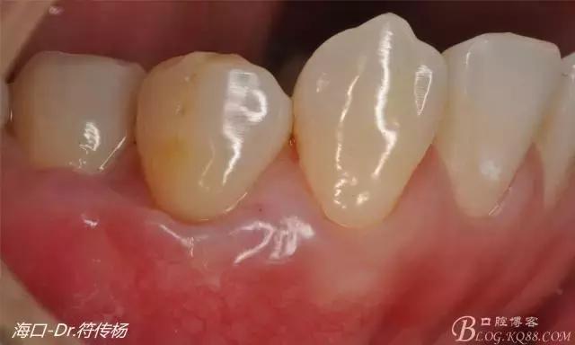 病例分享｜牙齦再生&根面覆蓋術(shù)
