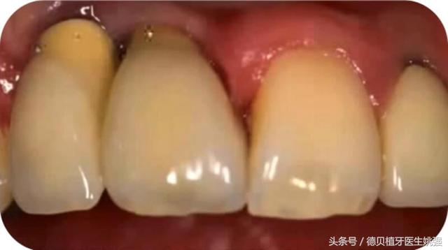 種植牙失敗的原因都有哪些？