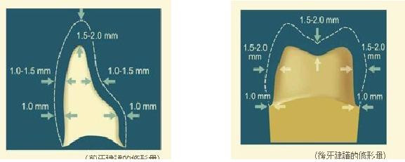 關(guān)于全瓷系列的牙體預備圖與介紹 - 濱海牙醫李 - 浩田齒科